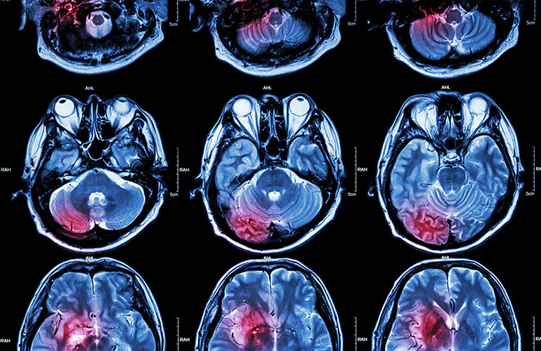 Your brain is starving for blood