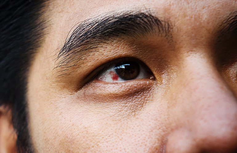 You see blood spots in your eyes
