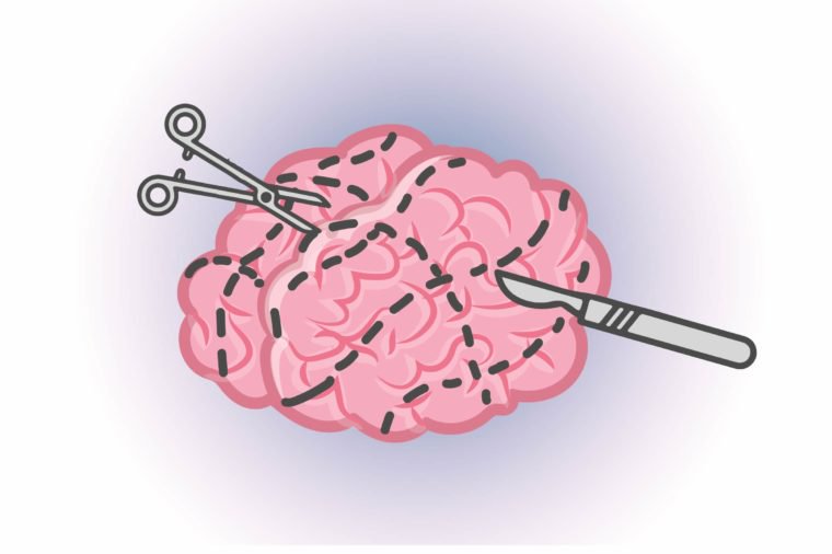 Surgical removal of almost half our brain is possible
