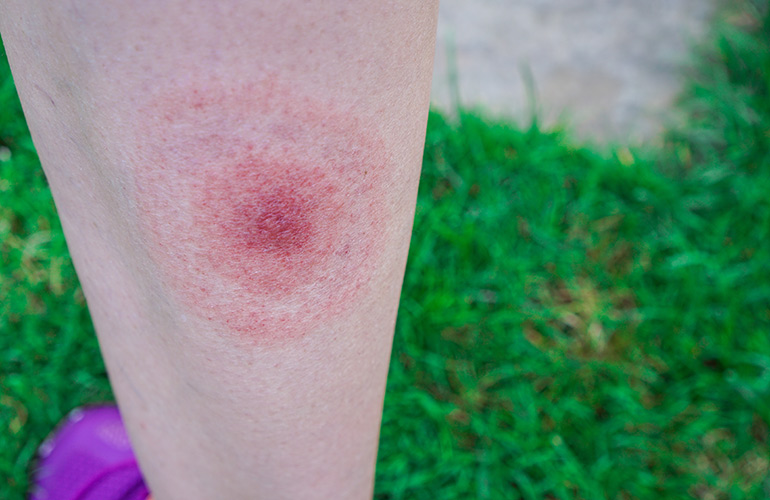 You develop a bulls-eye rash
