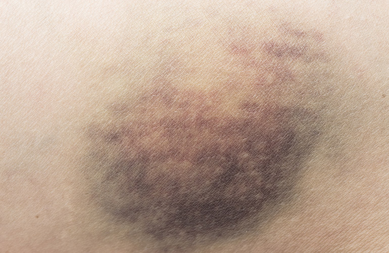 You bruise easily