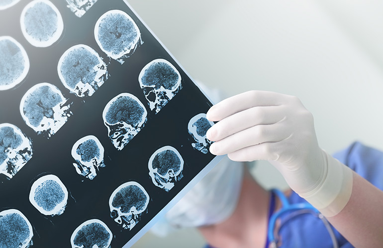 Parkinson's warning signs