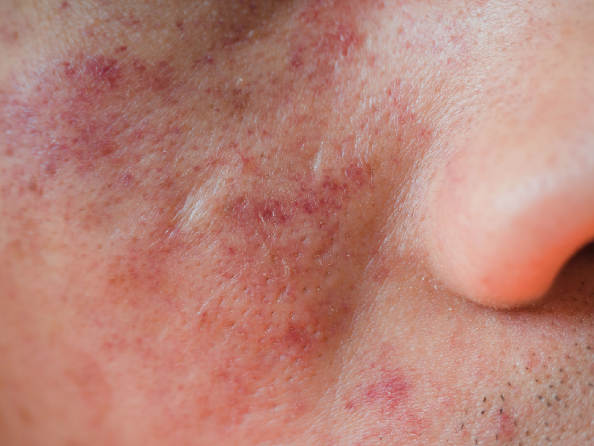 Rashes and blotches
