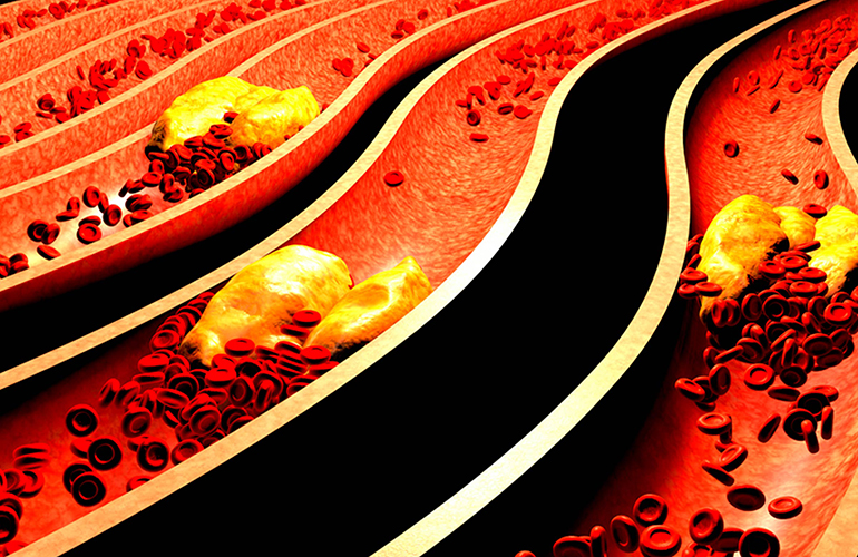 Blood clots: Type AB, A, and B increases risk