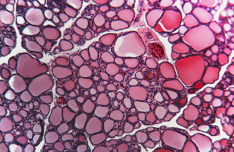 Thyroid cancer diagnoses appear to be surging