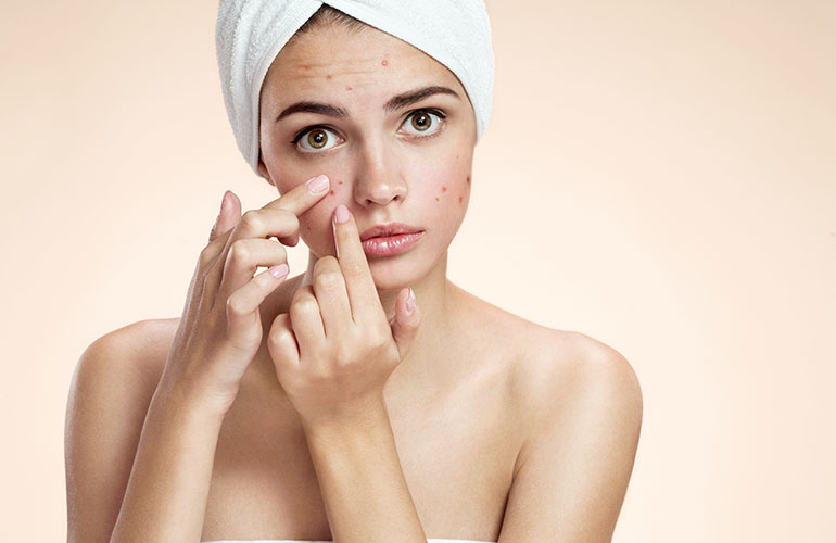 Garlic clears acne