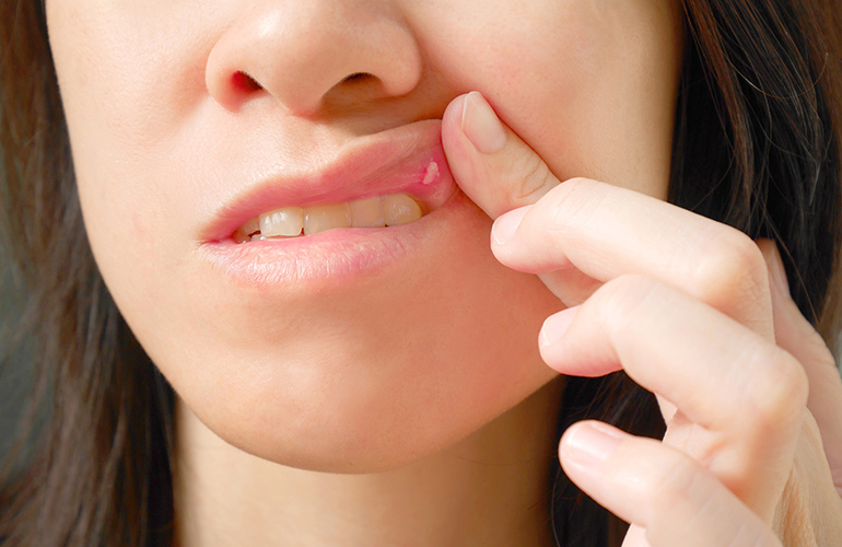 Neutralise mouth ulcers