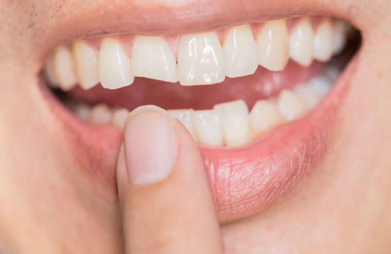 You crack a tooth