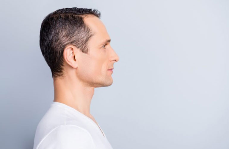 Gradually thinning hair