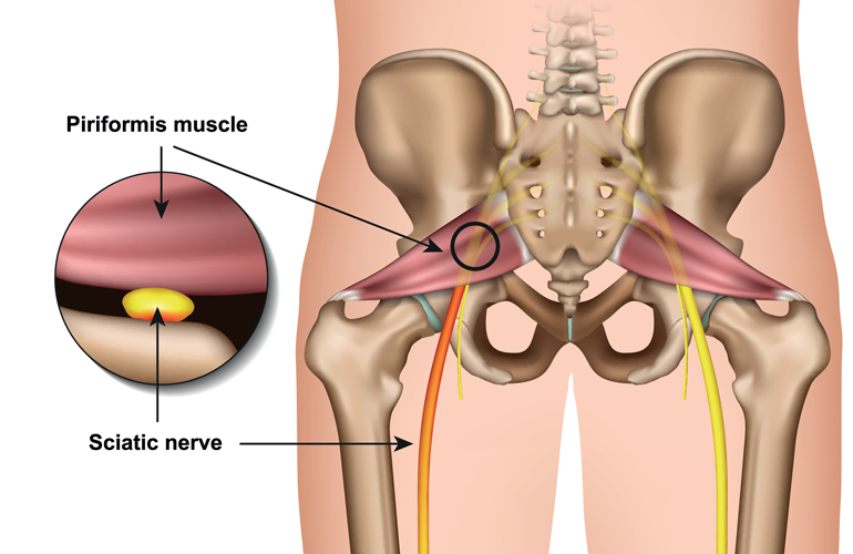 Could it be piriformis syndrome?