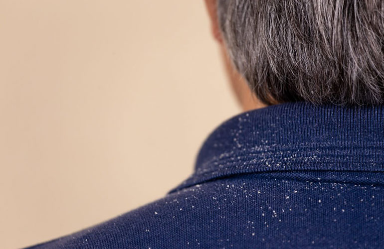 Dandruff
