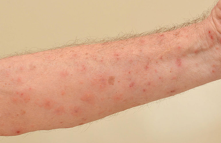 Scabies