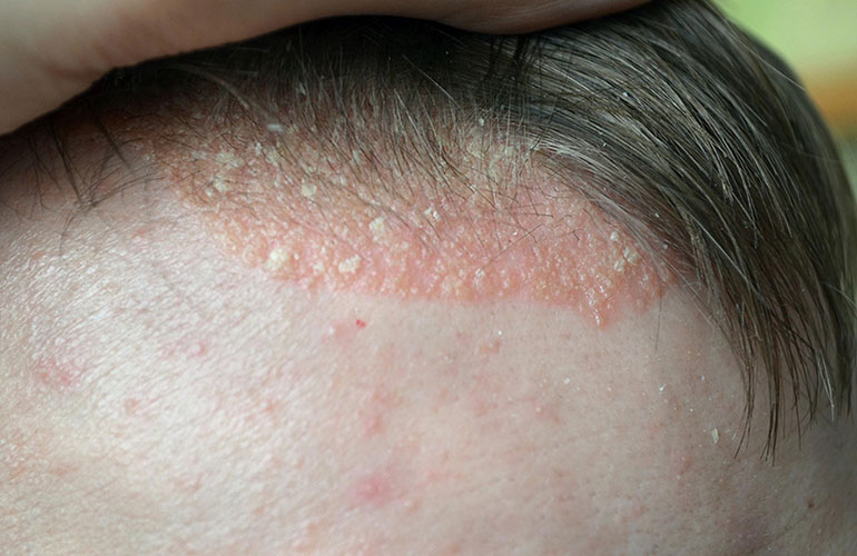 Psoriasis or eczema