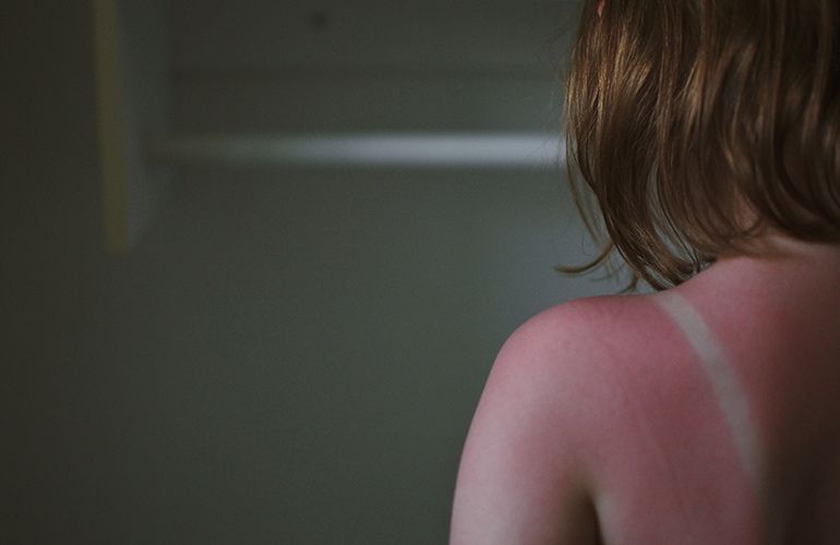 Sunburn