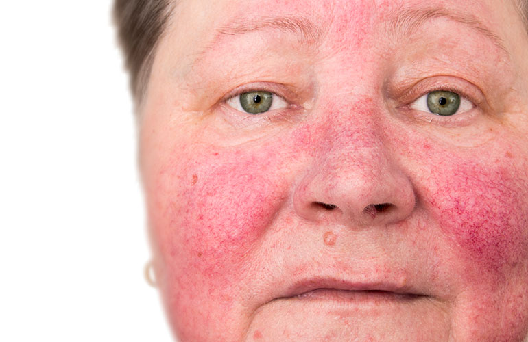 Rosacea