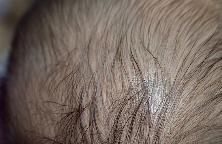 Alopecia areata