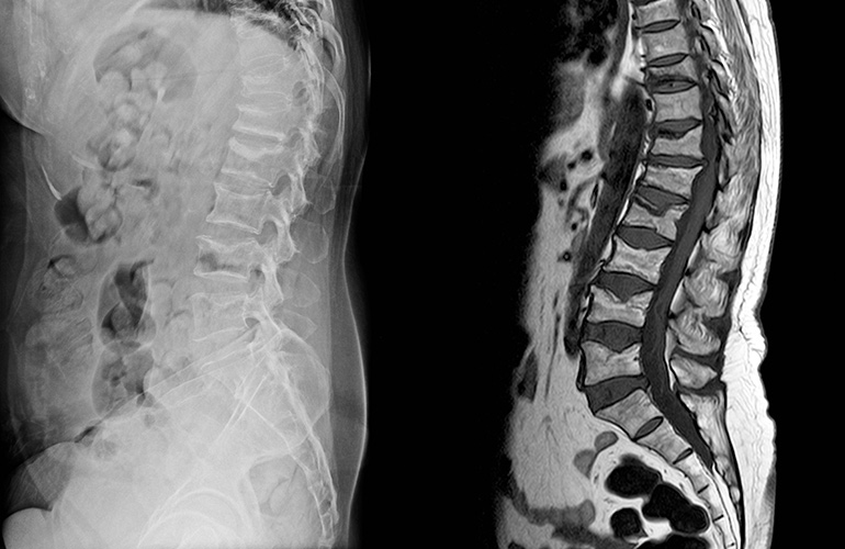Cervical spine disease