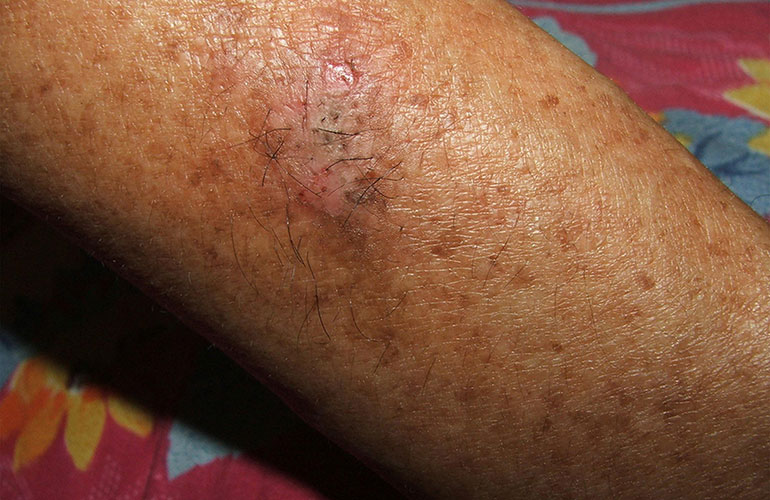 Lupus
