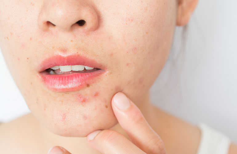 Choose oil-free or non-comedogenic products if you’re acne-prone.