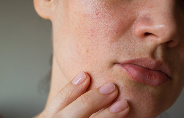 Got oily skin?