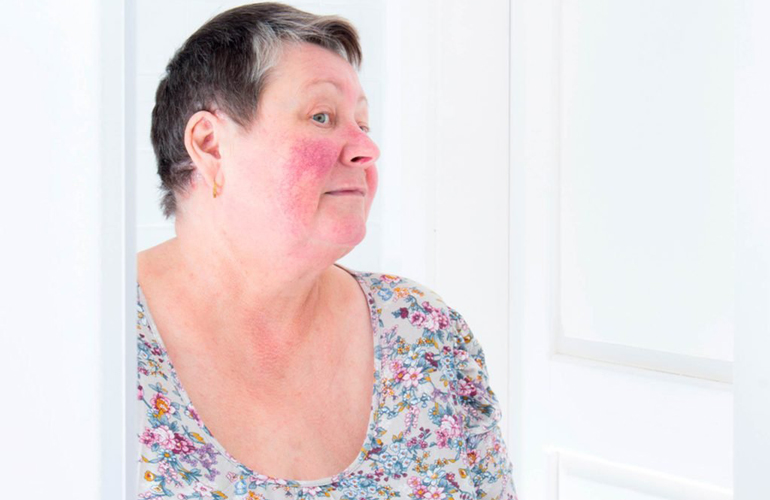 Rosacea