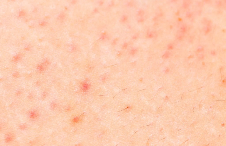 Folliculitis