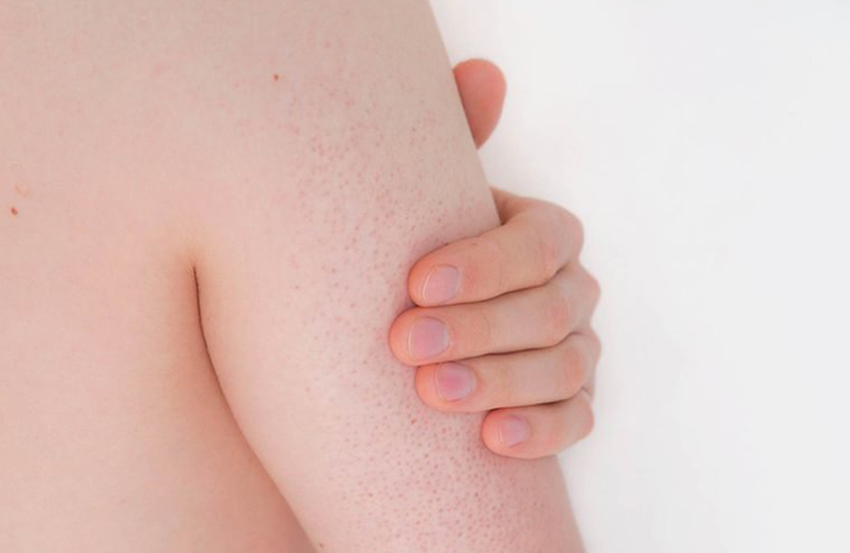 Keratosis pilaris