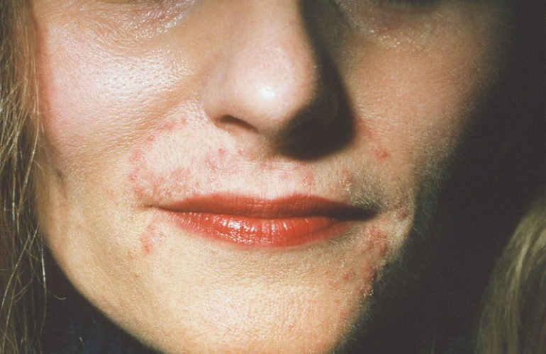 Perioral dermatitis