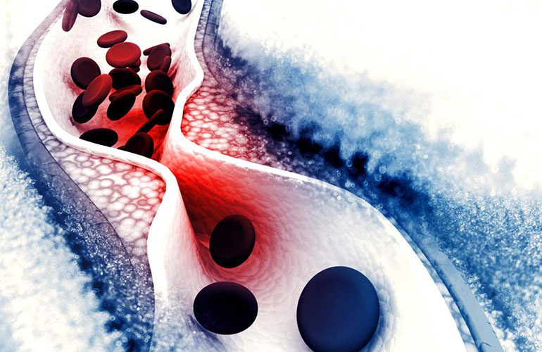 It may be peripheral artery disease