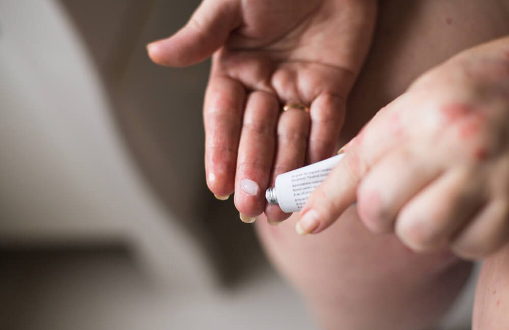 NSAID gels, drops, or patches are good options