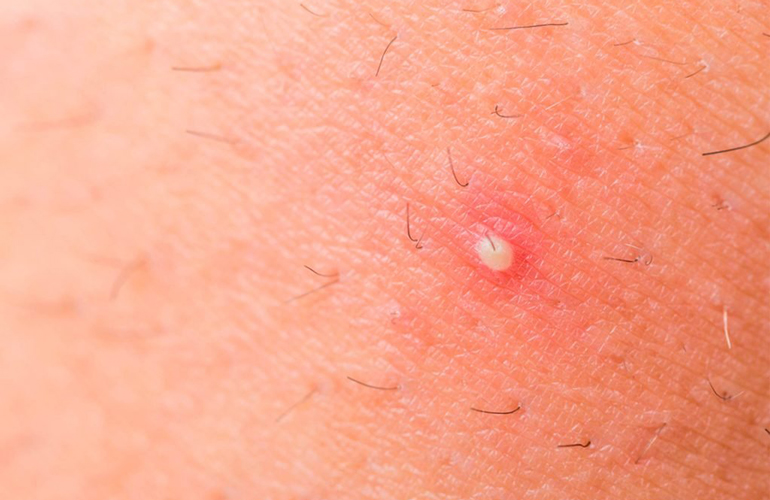 Ingrown hairs