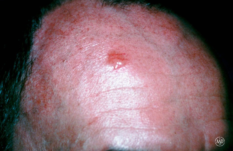Basal cell carcinoma