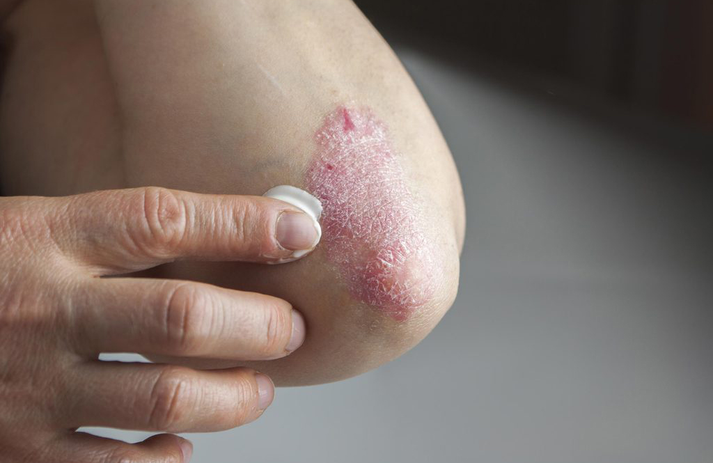 Psoriatic arthritis (PsA) is not RA