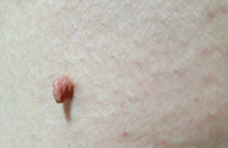 You notice lots of skin tags popping up