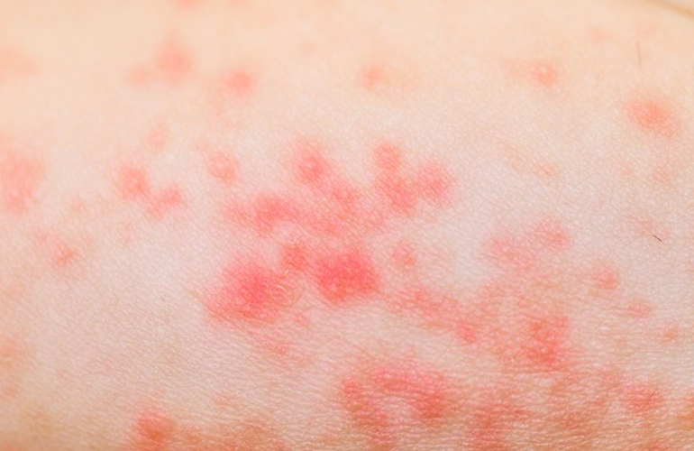 You have a weird rash, part II