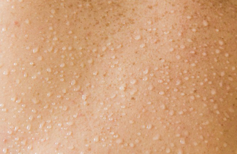 Your skin is sweaty and ruddy