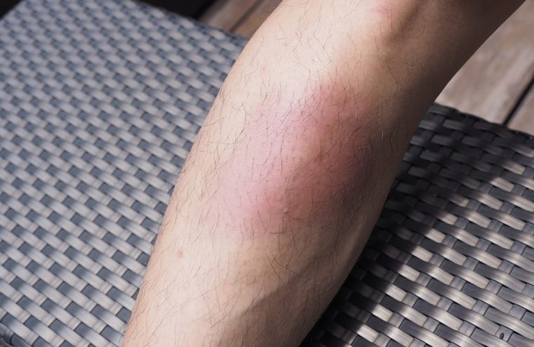Your lower legs are swollen and red
