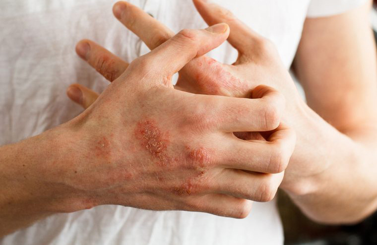 Thin or sore-filled skin could represent drug use