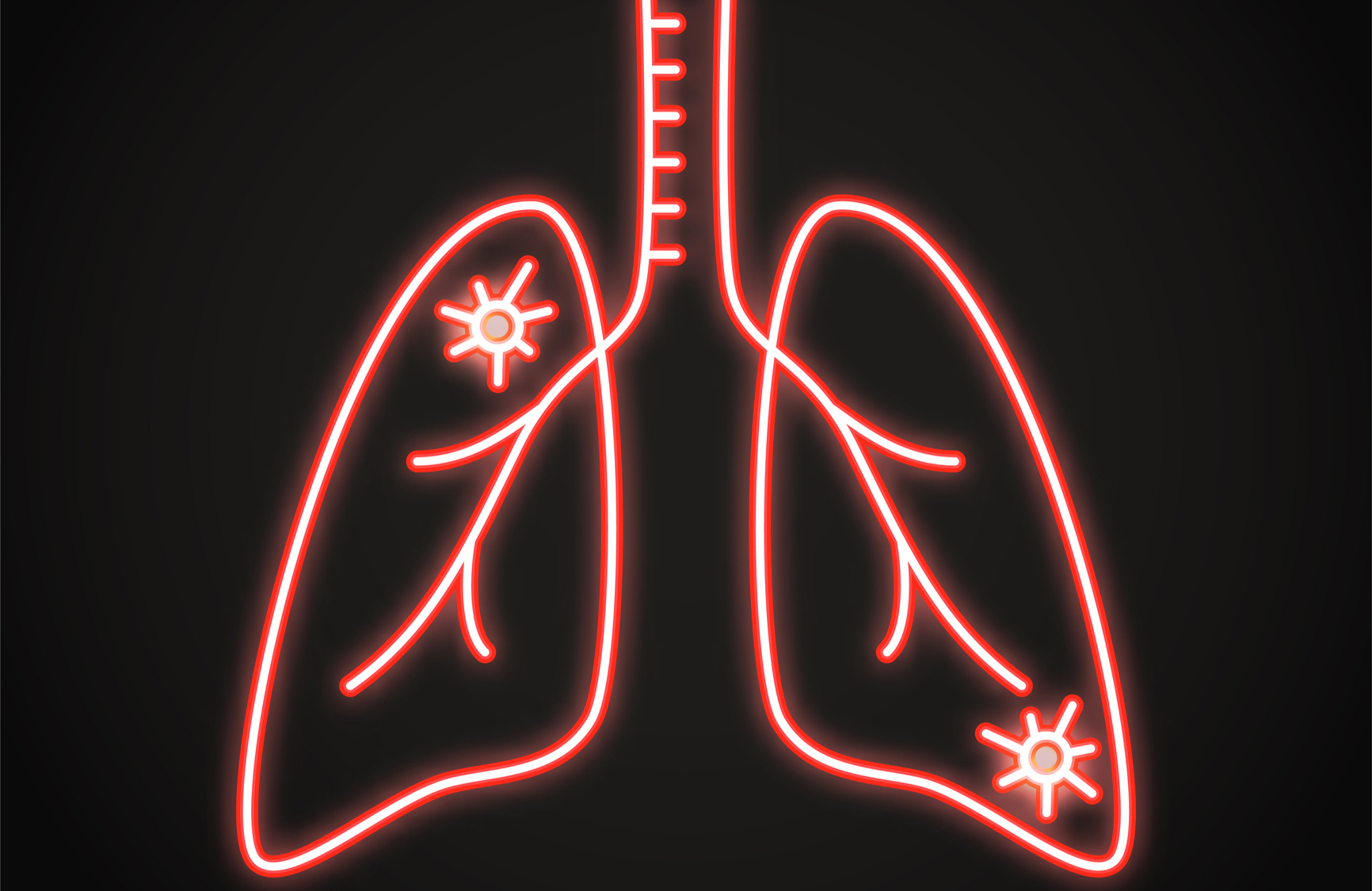 Non-small cell lung cancer