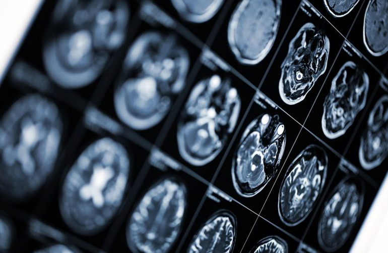 Depression isn’t necessarily caused by a chemical imbalance