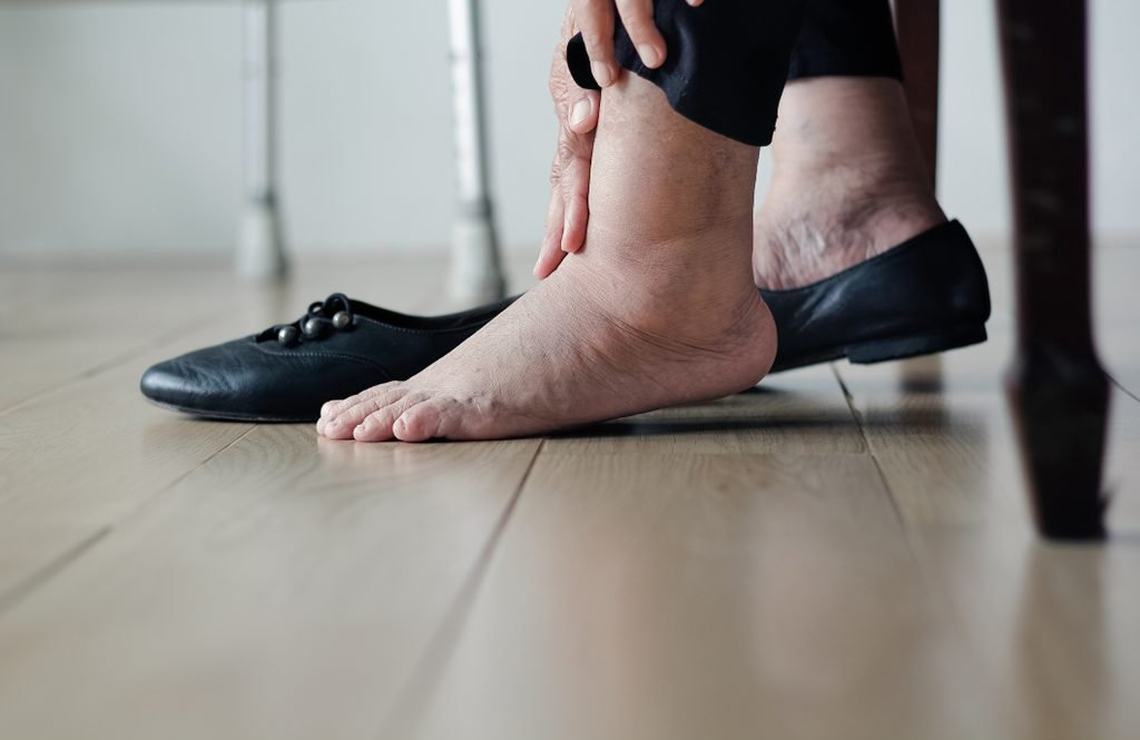Signs of heart trouble: Your feet and legs are swollen