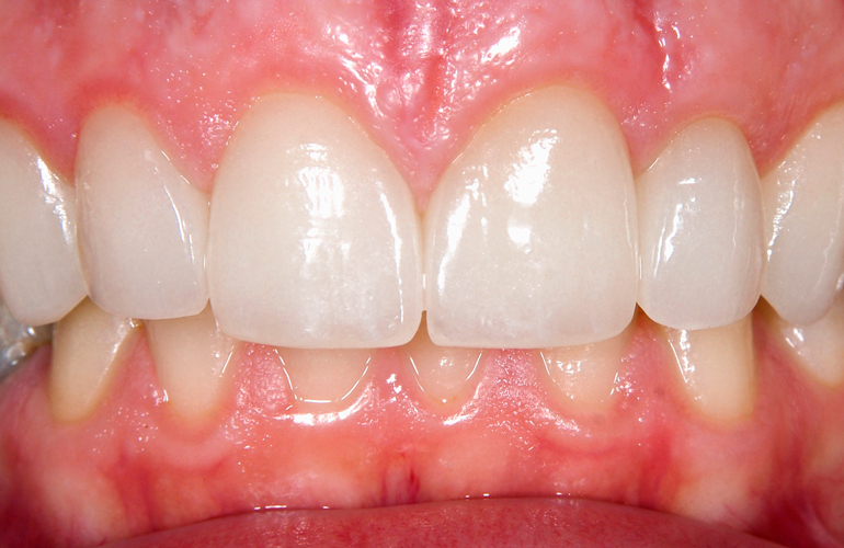 Your gums are receding
