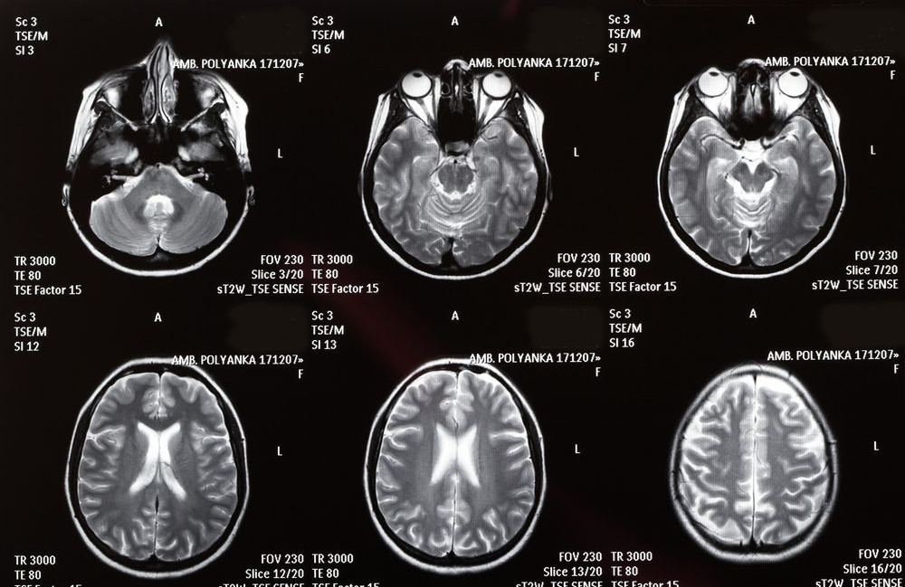 You’re at risk for psychotic disorders