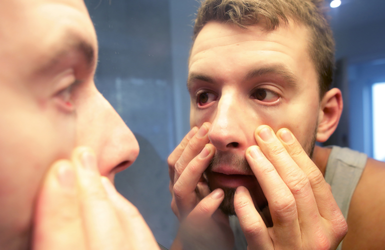 Treat minor eye inflammations