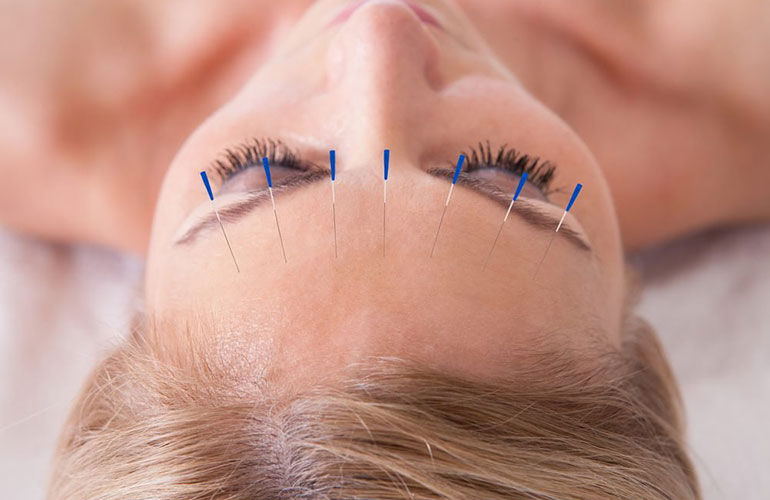 Facial acupuncture
