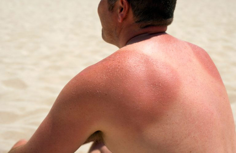Soothe a sunburn