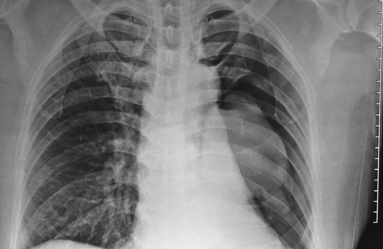 Bronchitis