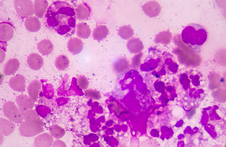 Sepsis