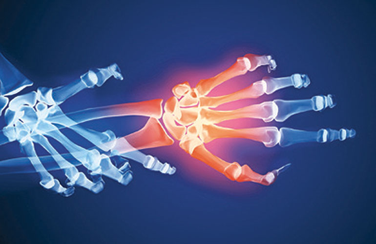 At-home arthritis relief