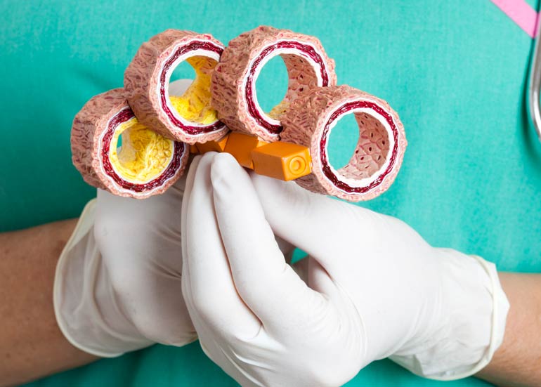 How common are clogged arteries?